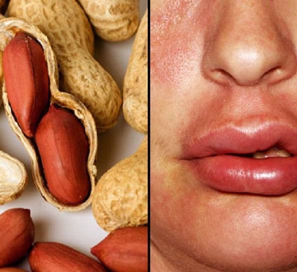 Аллергия на арахис - симптомы, у ребенка, может ли быть, у грудничка, как проявляется, причины, перекрестная